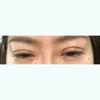 6日目の経過画像（2枚目）