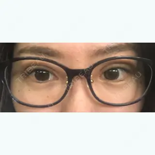 6日目の経過画像（2枚目）