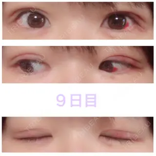 9日目の経過画像（1枚目）
