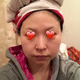 0日目の経過画像（2枚目）