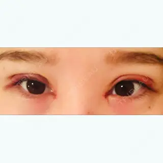 2日目の経過画像（1枚目）