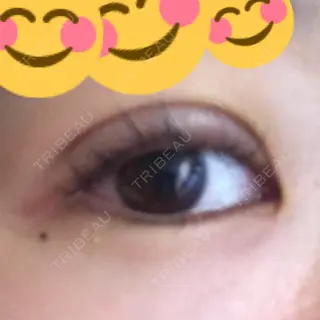 4日目の経過画像（1枚目）