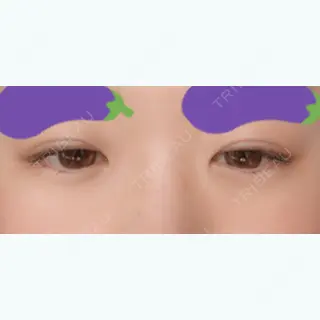 13日目の経過画像（2枚目）