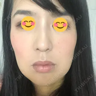 6日目の経過画像（1枚目）