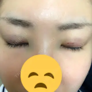 2日目の経過画像（2枚目）