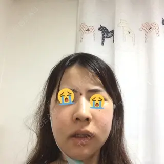 2日目の経過画像（1枚目）