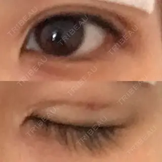 0日目の経過画像（2枚目）