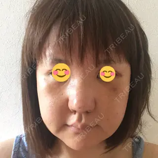 5日目の経過画像（1枚目）