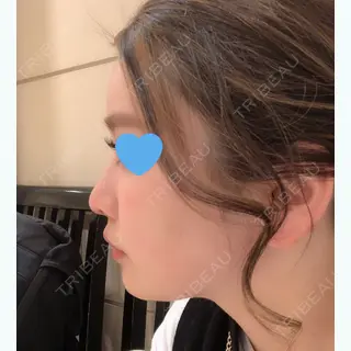 45日目の経過画像（2枚目）
