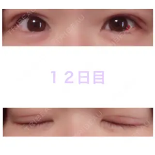 12日目の経過画像（1枚目）