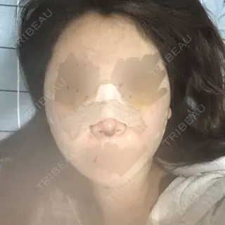 5日目の経過画像（1枚目）