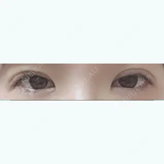 5日目の経過画像（1枚目）