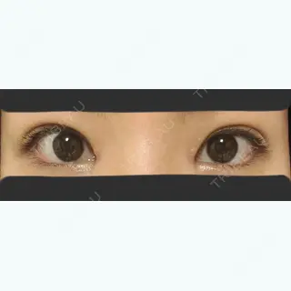 9日目の経過画像（1枚目）