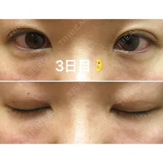3日目の経過画像（2枚目）