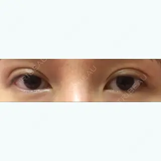 13日目の経過画像（1枚目）