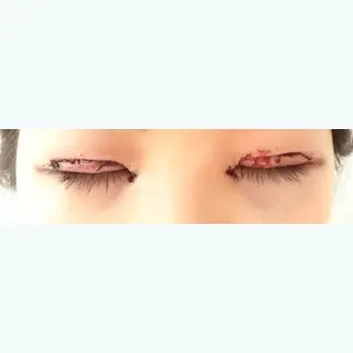 1日目の経過画像（2枚目）
