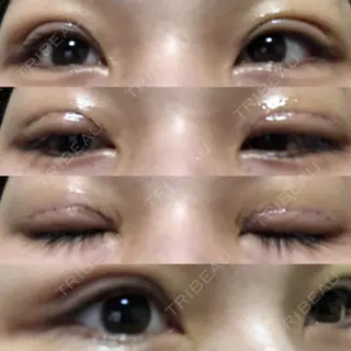 5日目の経過画像（1枚目）