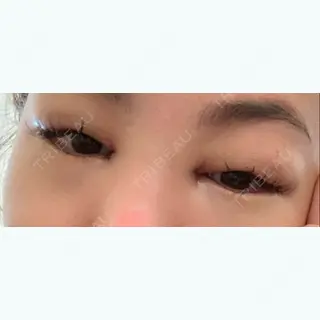 1日目の経過画像（2枚目）