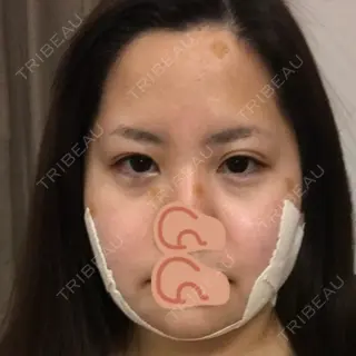 0日目の経過画像（1枚目）