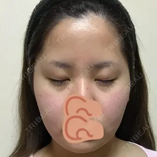 1日目の経過画像（1枚目）