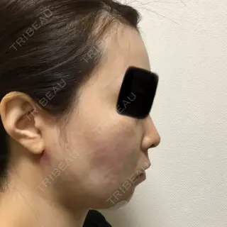 0日目の経過画像（3枚目）