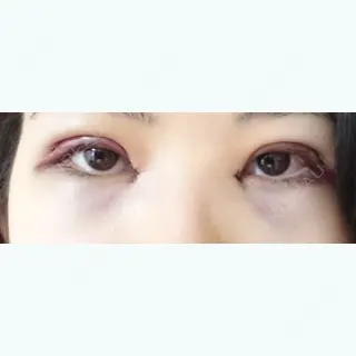 2日目の経過画像（1枚目）