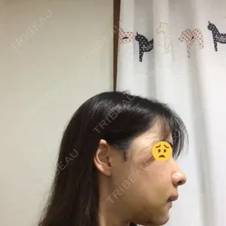 5日目の経過画像（2枚目）