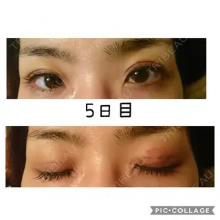 5日目の経過画像（1枚目）