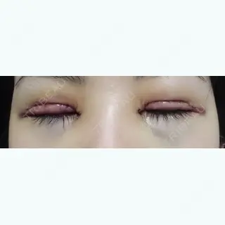 3日目の経過画像（2枚目）