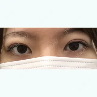 0日目の経過画像（1枚目）