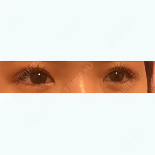 15日目の経過画像（1枚目）