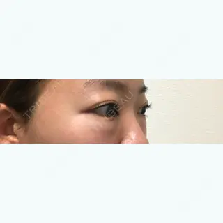 1日目の経過画像（2枚目）