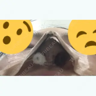 0日目の経過画像（3枚目）