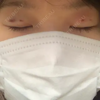 21日目の経過画像（2枚目）