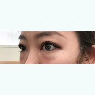 2日目の経過画像（3枚目）