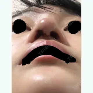 2日目の経過画像（1枚目）
