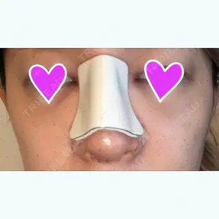 1日目の経過画像（1枚目）