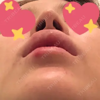 12日目の経過画像（3枚目）