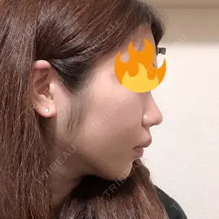 28日目の経過画像（3枚目）
