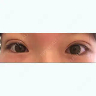 13日目の経過画像（1枚目）