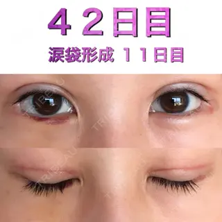 11日目の経過画像（1枚目）