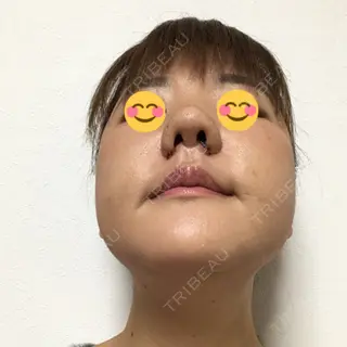 12日目の経過画像（2枚目）