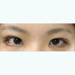 14日目の経過画像（1枚目）