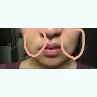 3日目の経過画像（2枚目）