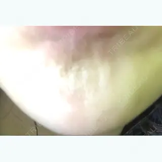 1日目の経過画像（1枚目）