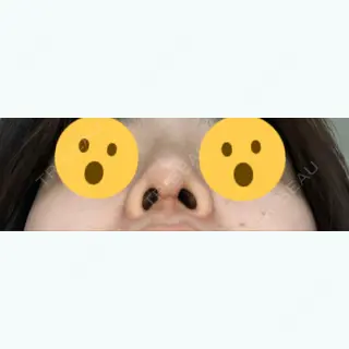12日目の経過画像（3枚目）