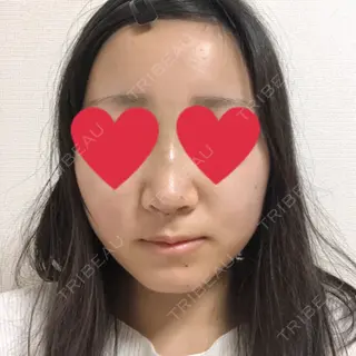 3日目の経過画像（1枚目）