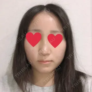 5日目の経過画像（1枚目）