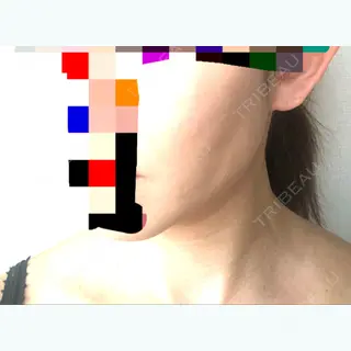 15日目の経過画像（2枚目）