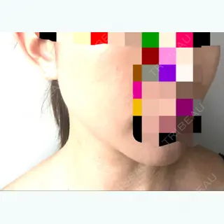 15日目の経過画像（3枚目）